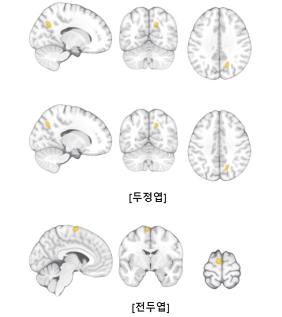 최정석 연구팀이 게임 중독이 뇌 기능 저하의 근거로 본 기능적 MRI 검사 결과